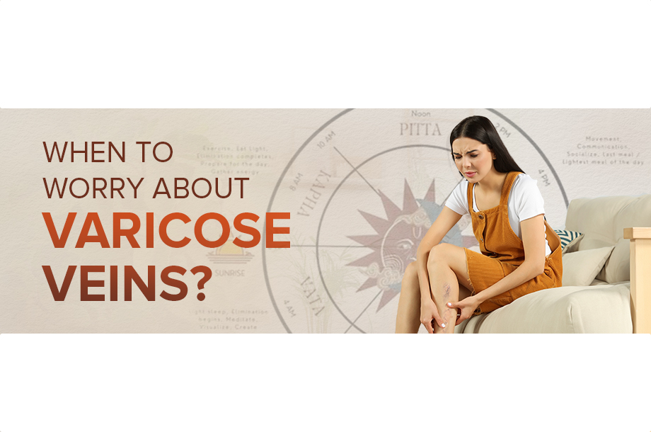 When To Worry About Varicose Veins?