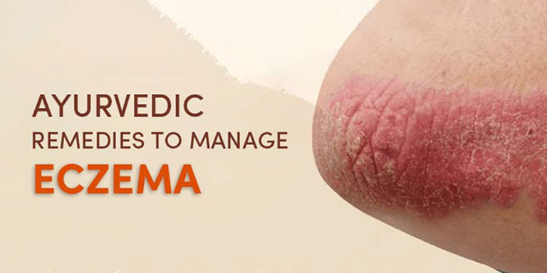 Ayurvedic Remedies To Manage Eczema 